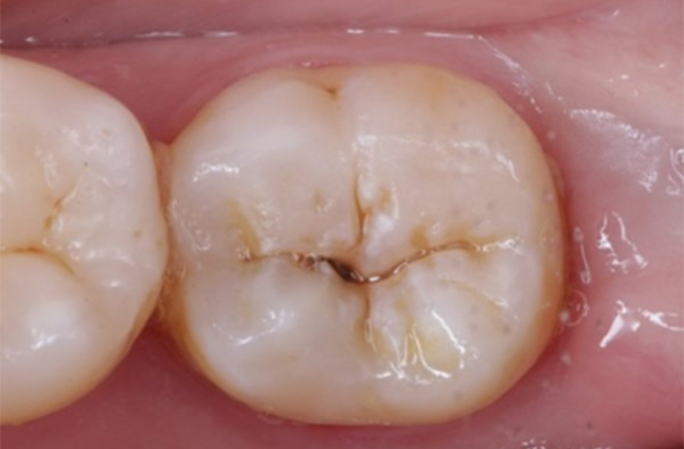 Técnica de estampado oclusal una alternativa para la Odontología restauradora moderna: Reporte de caso